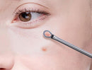 Kit de 4 Ferramentas de Acne Removedor de Cravo Espinha